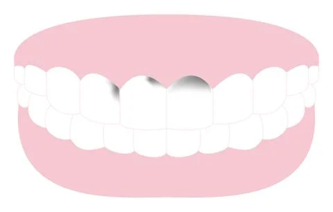 Illustration of tooth with decay advanced to front teeth Stock Illustration