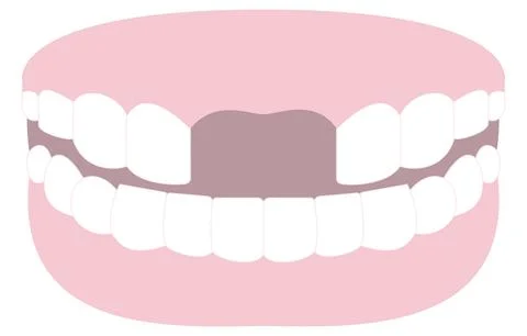 Illustration of tooth missing front teeth in Japan 스톡 일러스트