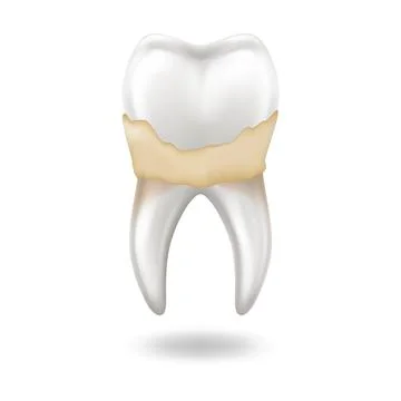 Illustration of Tooth with Plaque or Tartar Stock Illustration