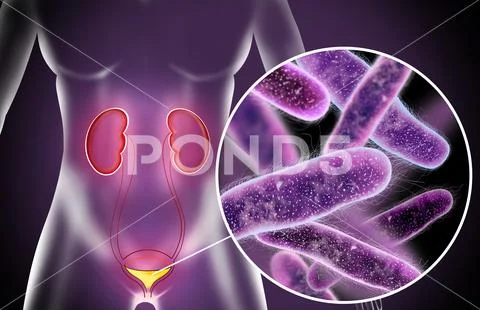 Illustration of woman suffering from cystitis. Urinary infection ...