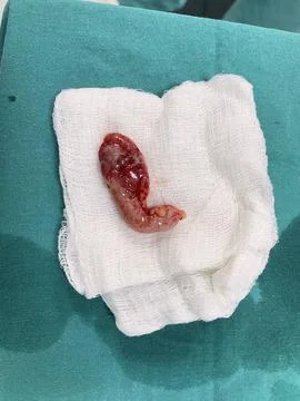 Image of Appendix Post-Appendectomy 2 Stock Photos