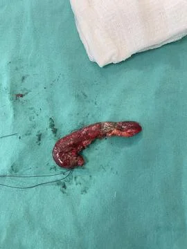 Image of Appendix Post-Appendectomy Foto stock