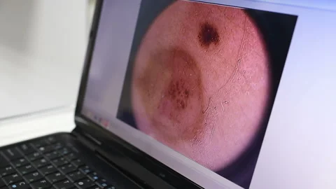 Image of a birthmark or warts close-up on a laptop monitor. 库存影片 100605049
