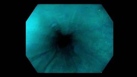 Image-Enhanced Endoscopy Mode Switching During Esophageal Examination Stock Footage 343178877