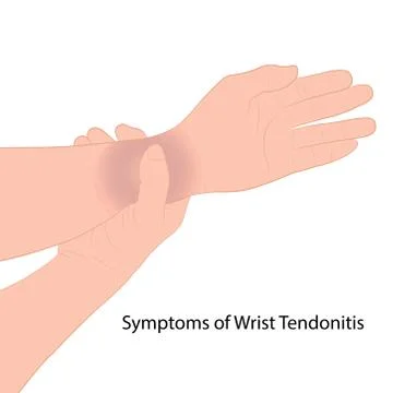 Image graphics vector outline Wrist pain is often caused by sprains Stock-Illustration
