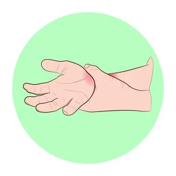 Image graphics vector outline Wrist pain is often caused by sprains Stock-Illustration