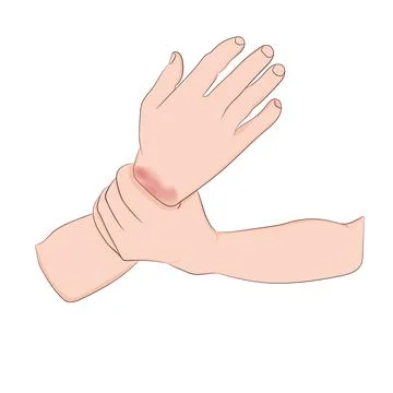 Image graphics vector outline Wrist pain is often caused by sprains Stock-Illustration