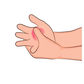 Image graphics vector outline Wrist pain is often caused by sprains Stock-Illustration