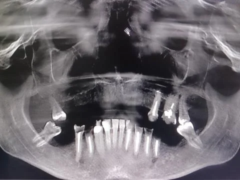 Image of a panoramic x-ray of teeth with coarse edentia. Stock Photos