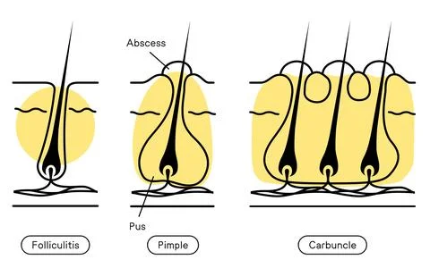Image of skin problems, rough skin, acne, early to advanced folliculitis Stock Illustration