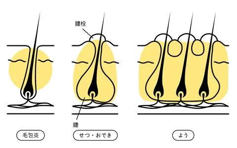 Image of skin problems, rough skin, acne, early to advanced folliculitis Stock Illustration