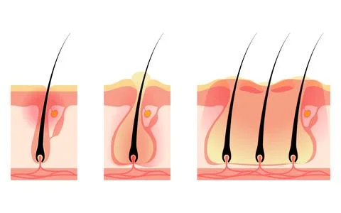 Image of skin problems, rough skin/acne, early to advanced folliculitis Stock Illustration