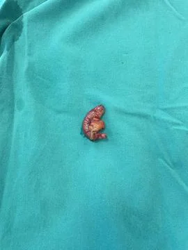Image of Surgically Removed Appendix After Inflammation  M3 Stock Photos