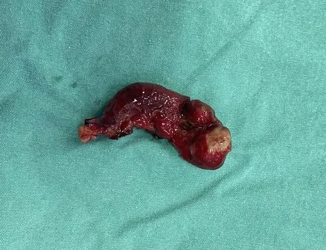 Image of Surgically Removed Appendix After Inflammation U3 Stock Photos