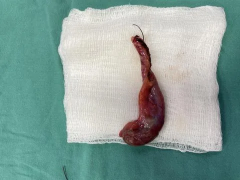 Image of Surgically Removed Appendix After Inflammation X7 Stock Photos