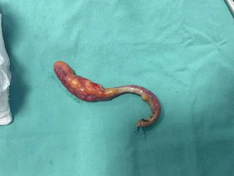 Image of Surgically Removed Appendix After Inflammation G1 Stock Photos