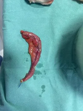 Image of Surgically Removed Appendix After Inflammation  App11 Stock Photos