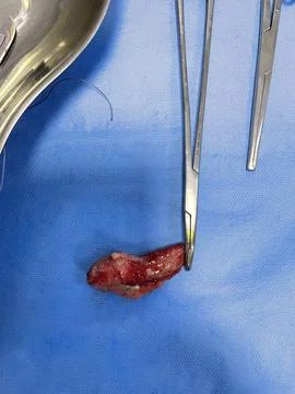 Image of Surgically Removed Appendix After Inflammation Q2 Stock Photos