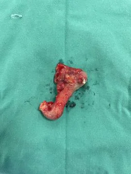 Image of Surgically Removed Appendix After Inflammation  W1 Stock Photos