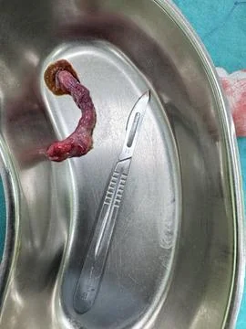 Image of Surgically Removed Appendix After Inflammation N1 2 V24 Stock Photos