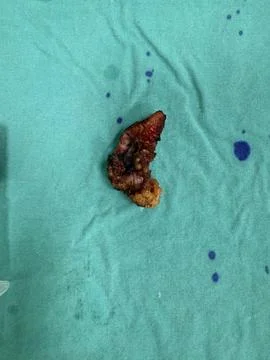 Image of Surgically Removed Appendix After Inflammation N10 V25 Foto stock