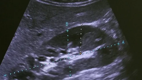 Image of woman uterus on monitor ultrasound examination equipment. Stock Footage