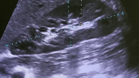 Image of woman uterus on monitor ultraso... | Stock Video | Pond5