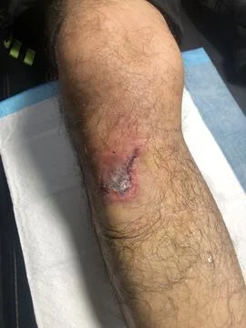 Image of wounded leg Stock Photos