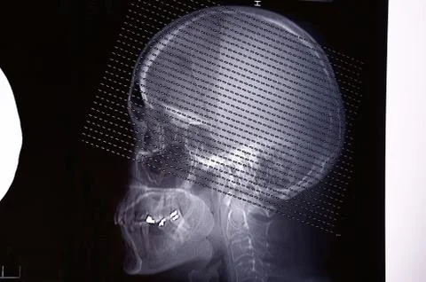 Images from a computerized tomography of the brain Stock Photos