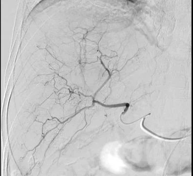 Imaging of TACE or Chemoembolization is a procedure that allows a dose of c.. Stock Illustration