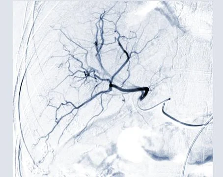 Imaging of TACE or Chemoembolization is a procedure that allows a dose of c.. Stock-Illustration