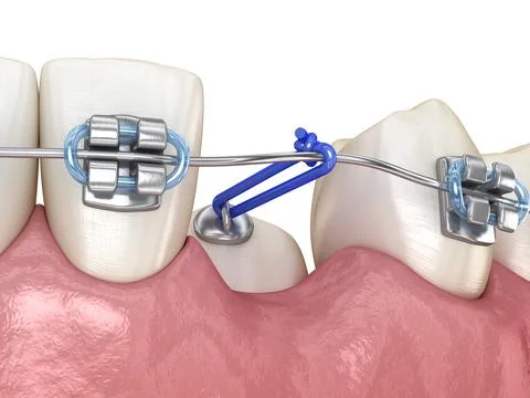 Impacted Cuspid and elastic for correction. Medically accurate dental 3D illu Stock Illustration