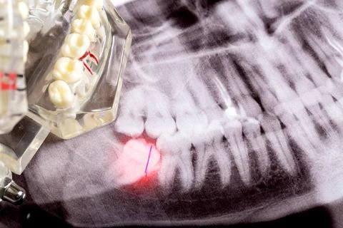 Impacted wisdom teeth on an X-ray picture with an inflamed cyst neoplasm Stock-Fotos