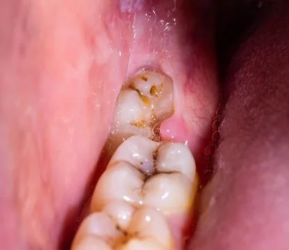 Impacted wisdom tooth due to which a gum hood was formed. Inflammation of the Фото
