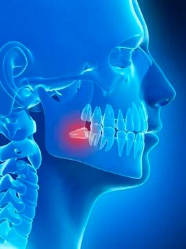 Impacted wisdom tooth, illustration Stock Illustration
