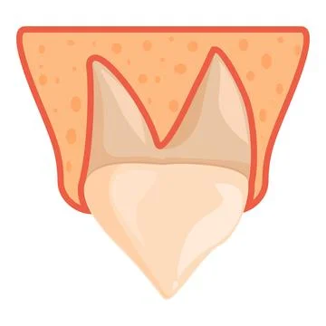 Impacted wisdom tooth under gum line, showing stage of eruption Stock Illustration