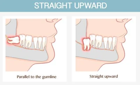 Impacted wisdom tooth  vector illustratin Stock Illustration