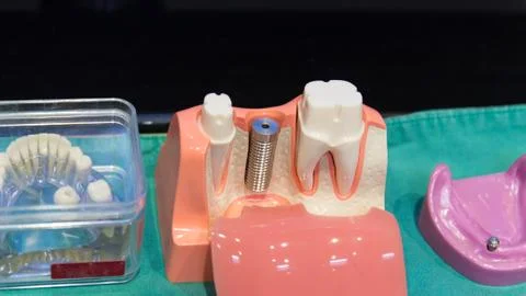 The implant substructure teeth model Stock Photos