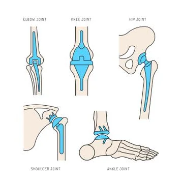Implantation joint skeleton Stock Illustration
