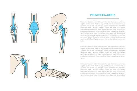 Implantation joint skeleton Stock Illustration