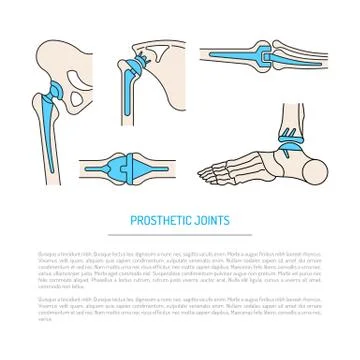 Implantation joint skeleton Stock Illustration