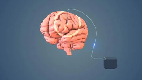 Implanted Neurostimulator Connected to Human Brain Stock Illustration
