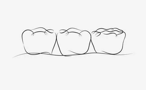 Implanted teeth with crown bridge white color Stock Illustration