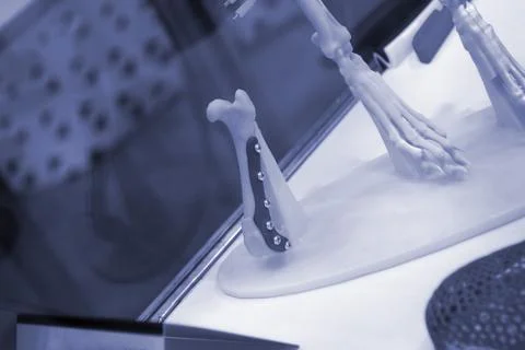 Implants and prostheses printed on 3D printer from biocompatible titanium powder Stock Photos