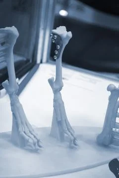 Implants and prostheses printed on 3D printer from biocompatible titanium powder Stock Photos