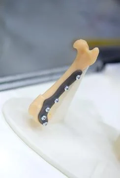 Implants and prostheses printed on 3D printer from biocompatible titanium powder Stock Photos