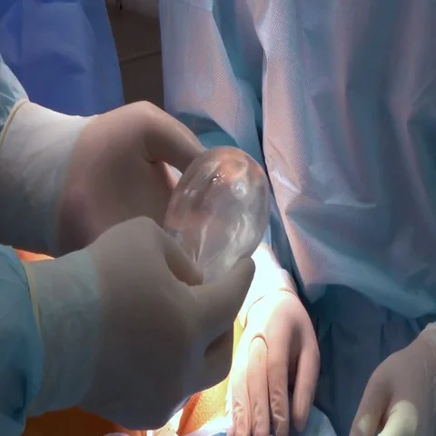 Implants to increase the buttocks Stockbeeldmateriaal 69567559