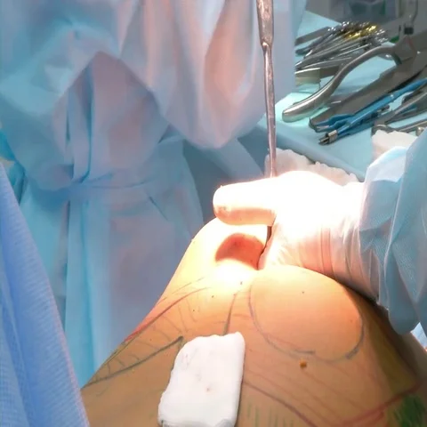 Implants to increase the buttocks Stock Footage 69569823