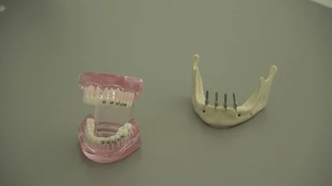 Implants teeth made in the technic Opaque porcelain dental. Stock Footage 105570622