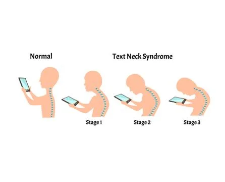 Improper posture symptoms. Stage Text Neck Syndrome. Spinal curvature, kyphosis Stock Illustration